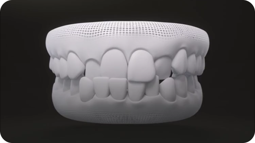인비절라인 치료 전후 치아 배열을 보여주는 3D 구강 모델