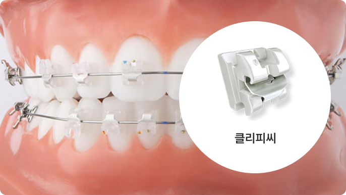 클리피씨 시술 이미지