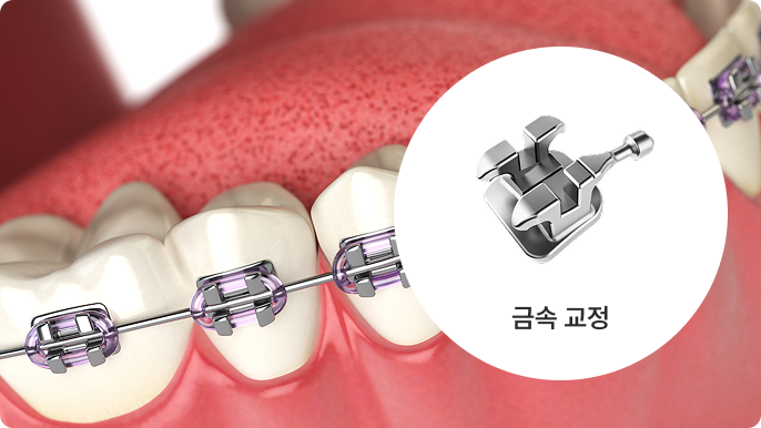 일반 브라켓 시술 이미지